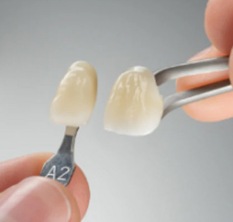 Best 3M PFM dental crowns South Delhi India