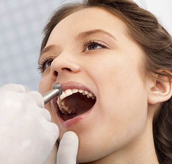 Laser teeth whitening cost in delhi