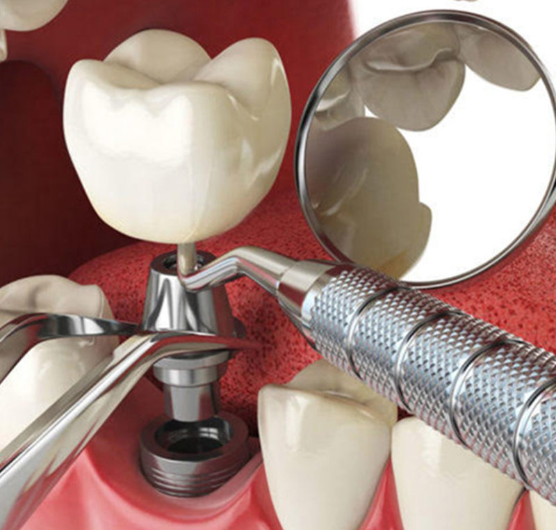 Dental Implant