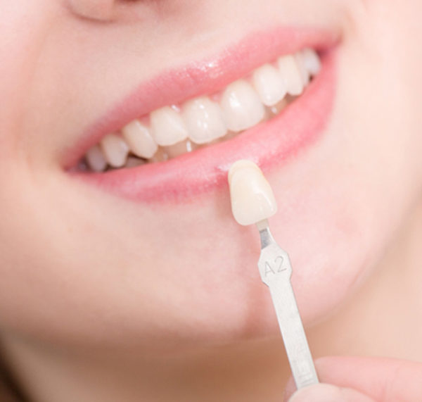 Best Dental Veneers in India Veneers Cost in Delhi, India Goel Dental