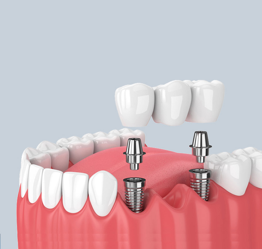 Low cost multiple teeth replacement with Dental Implants South Delhi India