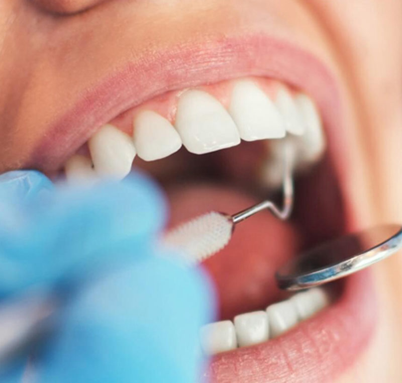 Low cost Single Tooth dental implants South Delhi India