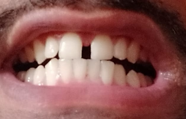 Front teeth gap