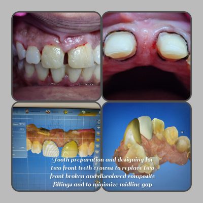 Gap correction with crown