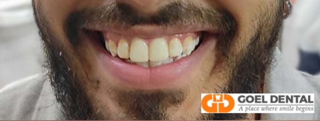 2 front teeth veneers