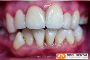 After emax veneer fixing