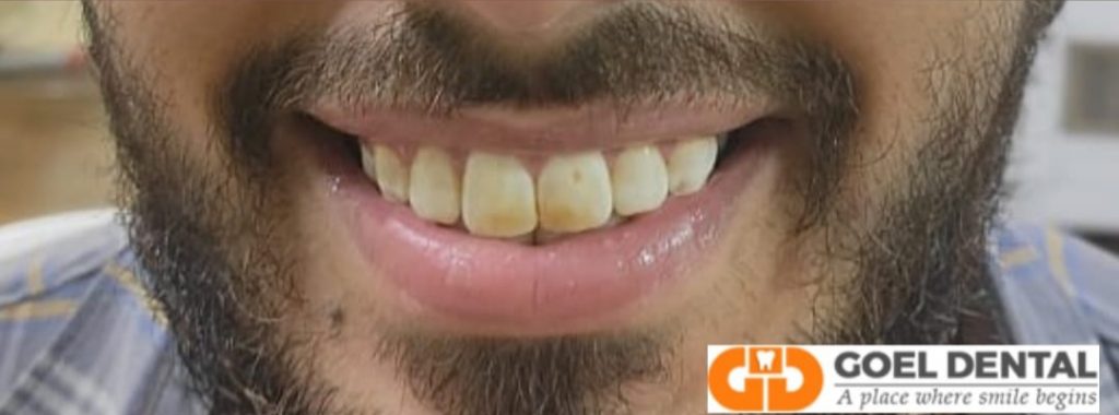 Teeth with stains