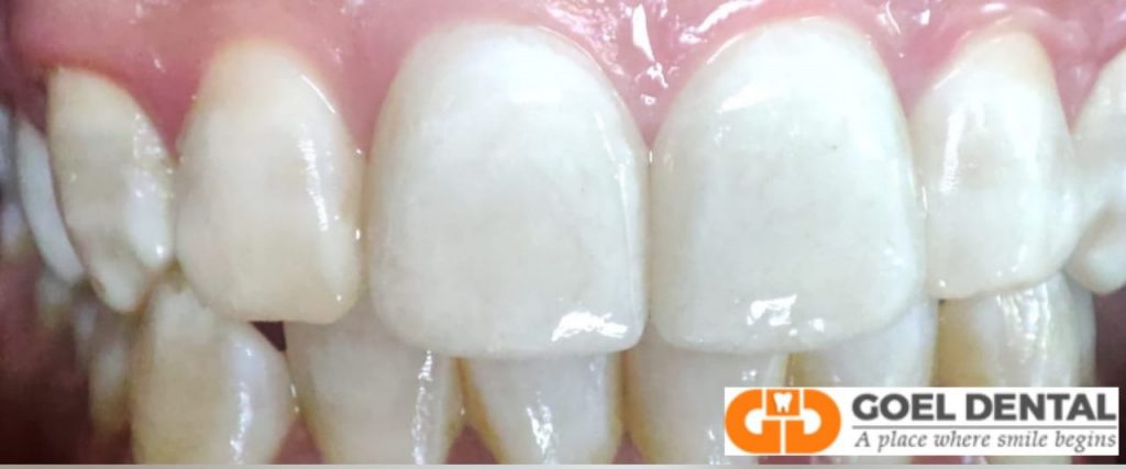 Close up of 2 upper front teeth veneers